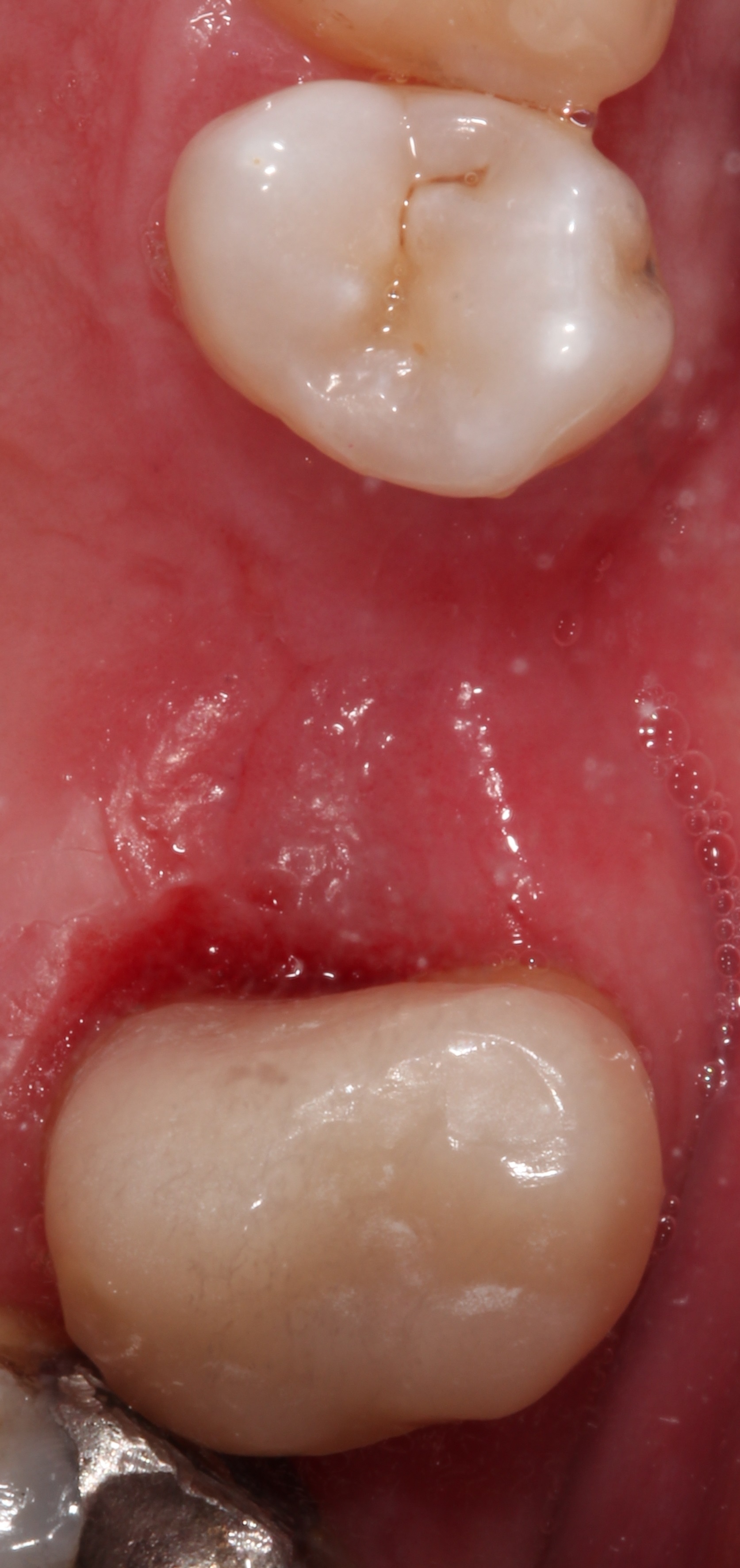 cerec crowns 0