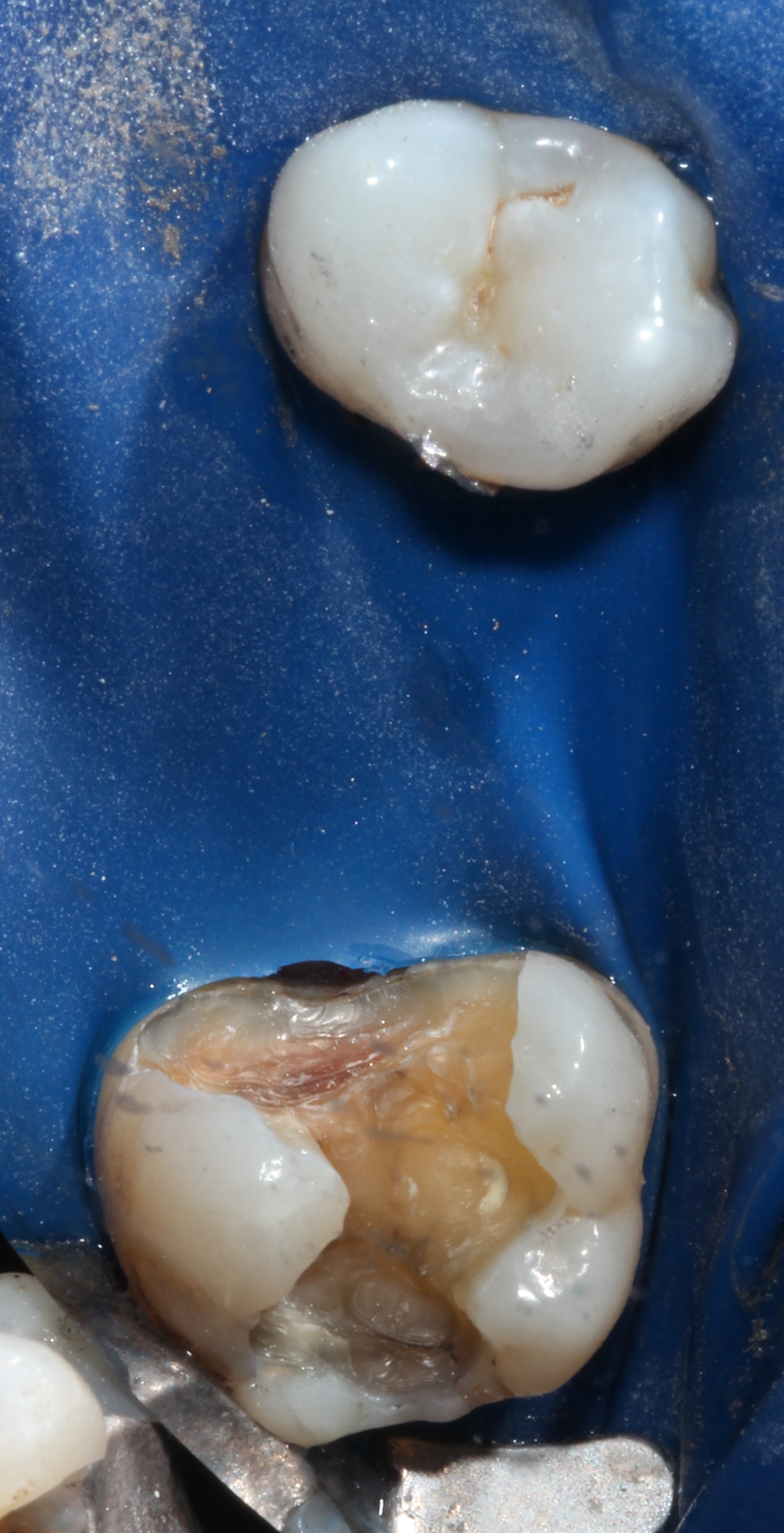 cerec crowns 3