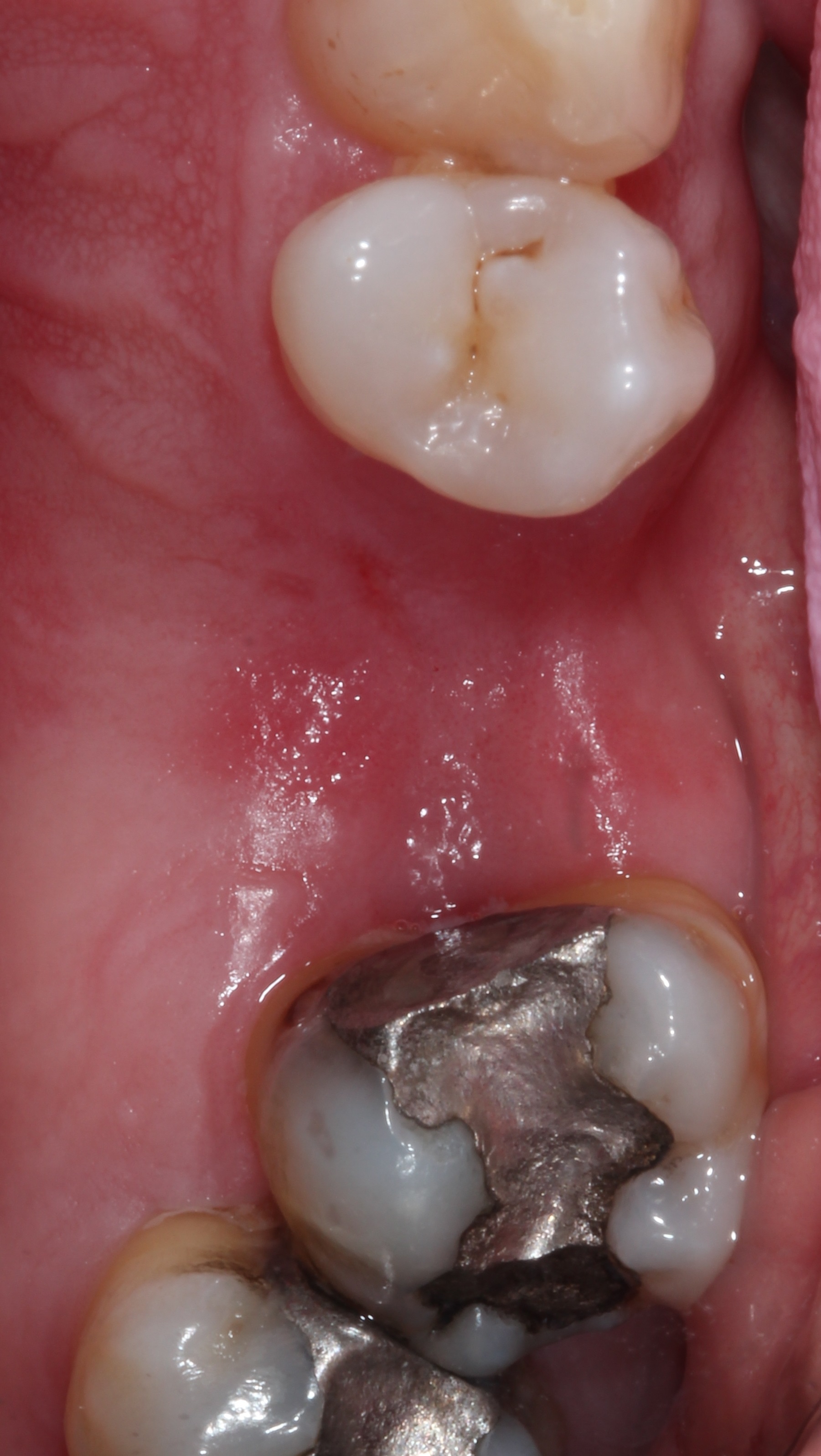 Cerec crowns 4