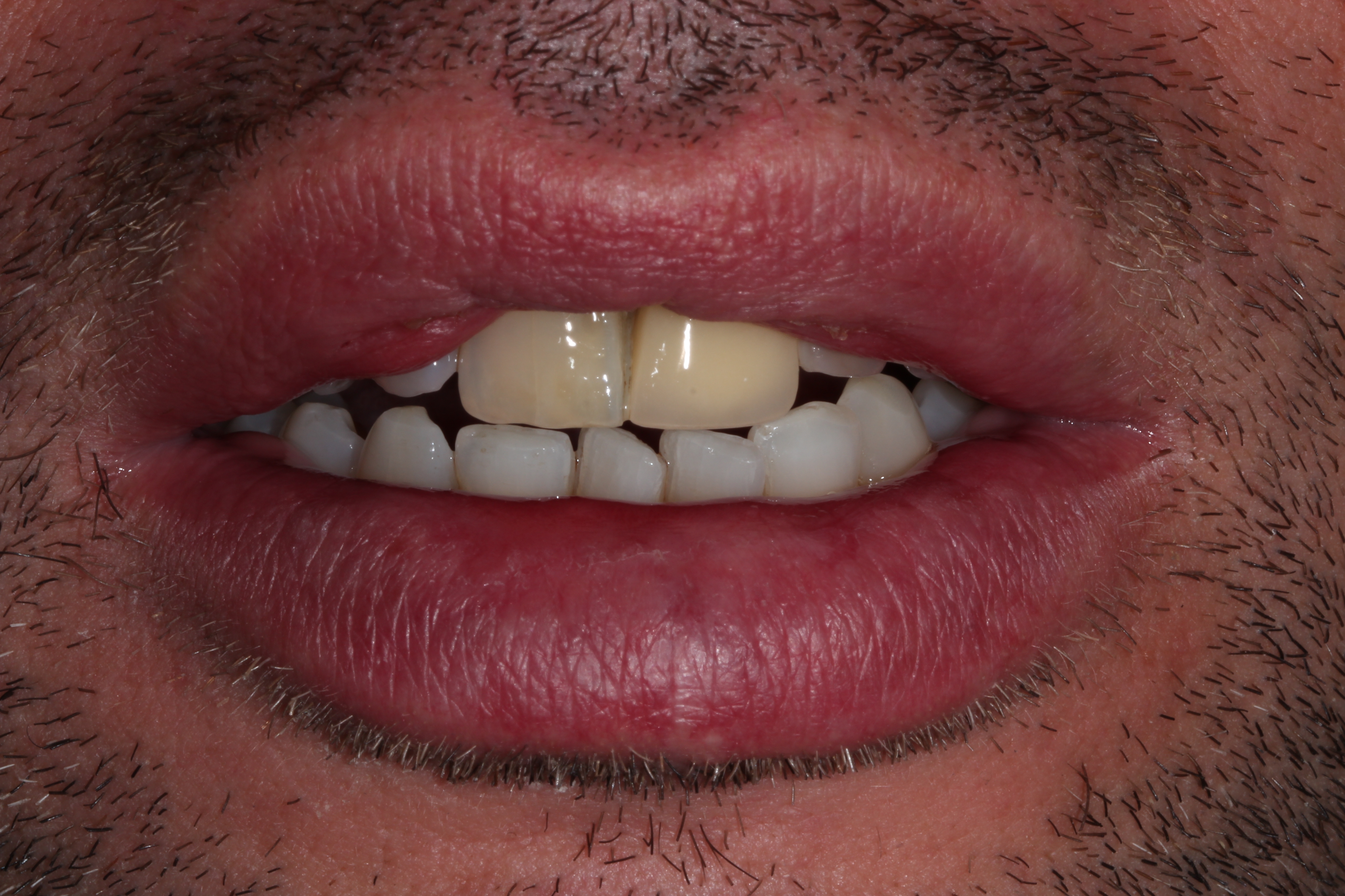 Before Treatment (B)