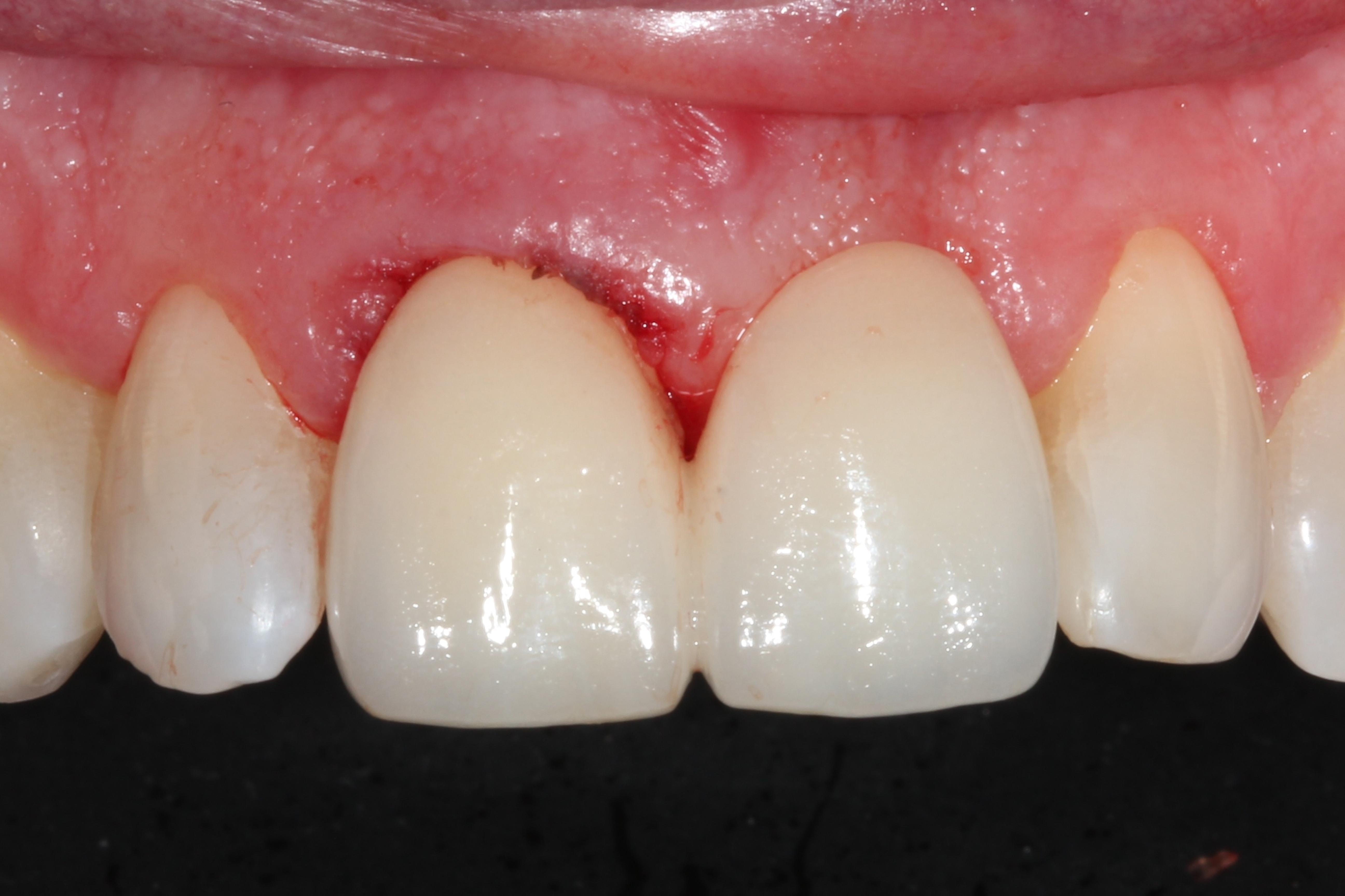 End of patients treatment