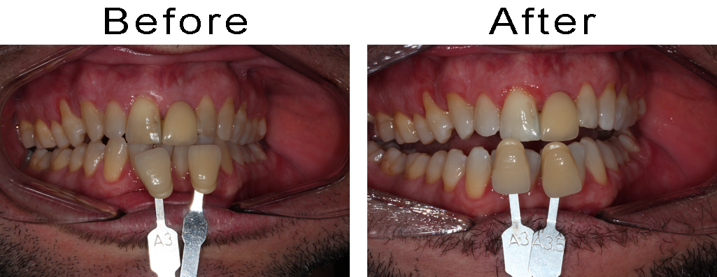 Before and after teeth whitening