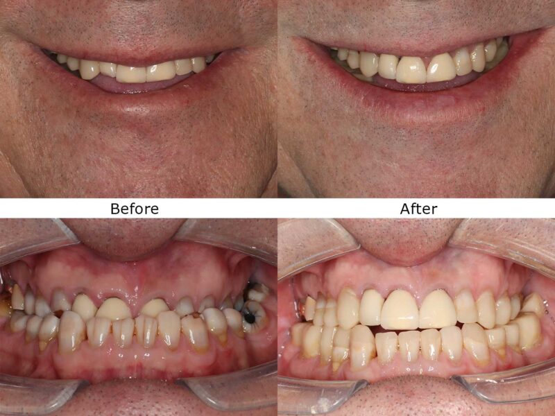 Stain-and-Missing-Teeth-Treatment